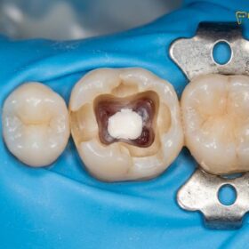 Vital Pulp Therapy Crowns: Clinical Protocols & Root Canal Alternatives