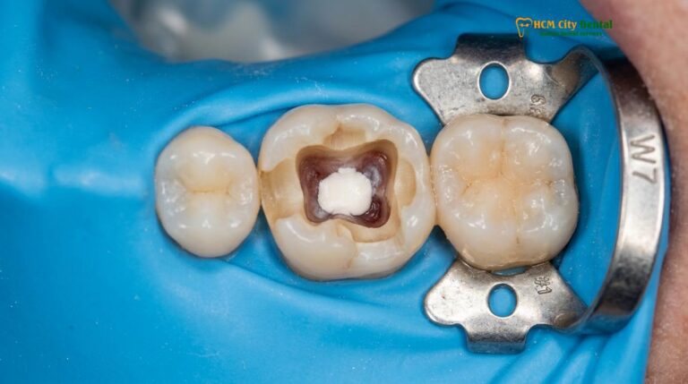 Vital Pulp Therapy Crowns: Clinical Protocols & Root Canal Alternatives