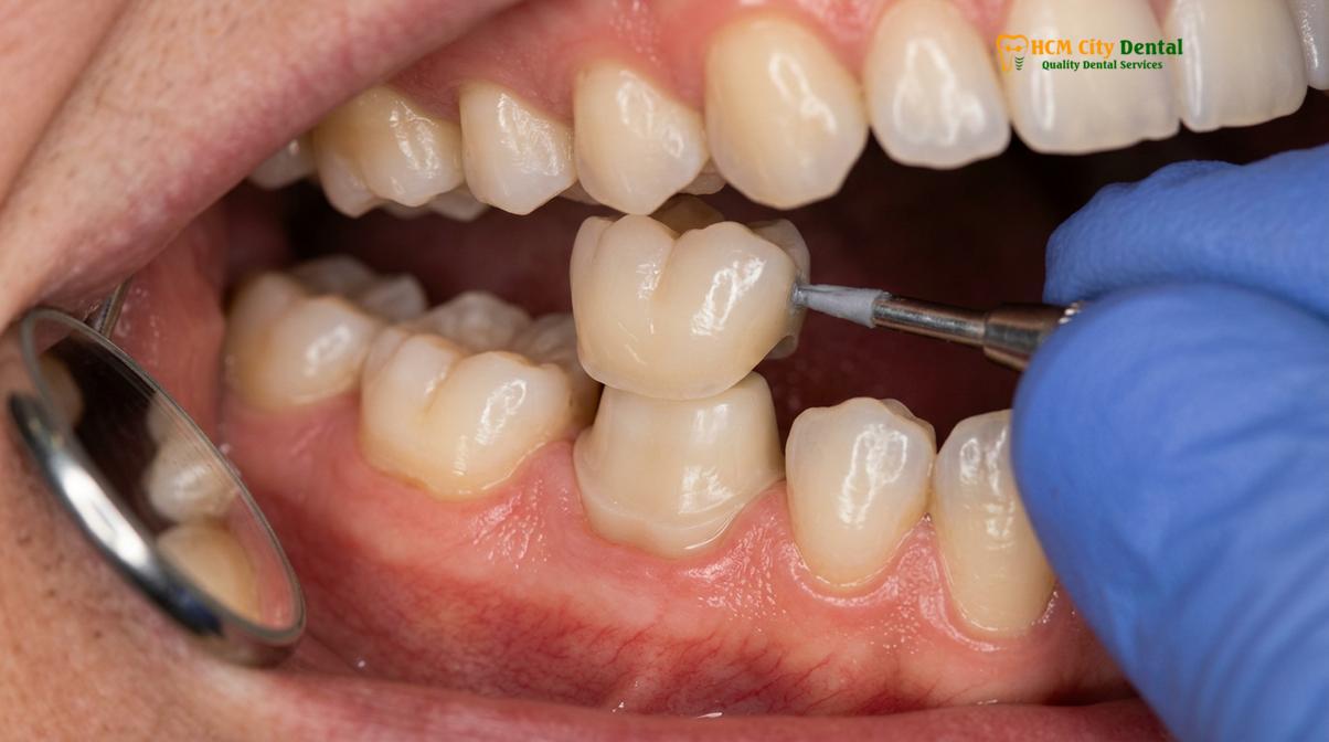Visual description of vital pulp therapy crowns