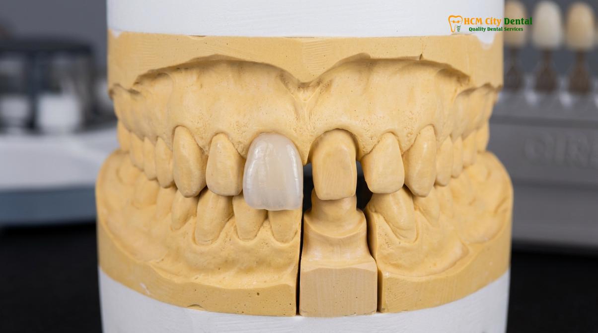 Visual description of porcelain veneers warranty vietnam