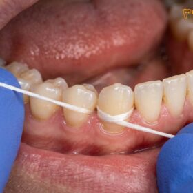 Water Flosser vs String Floss & Scaling: A Clinical Comparison