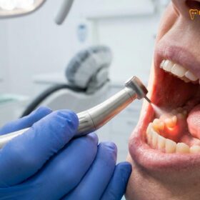 Waterlase Laser Gums: Clinical Efficacy in Painless Gum Contouring