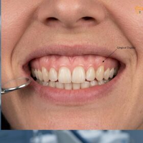 What Causes a Gummy Smile? The 5 Main Clinical Reasons