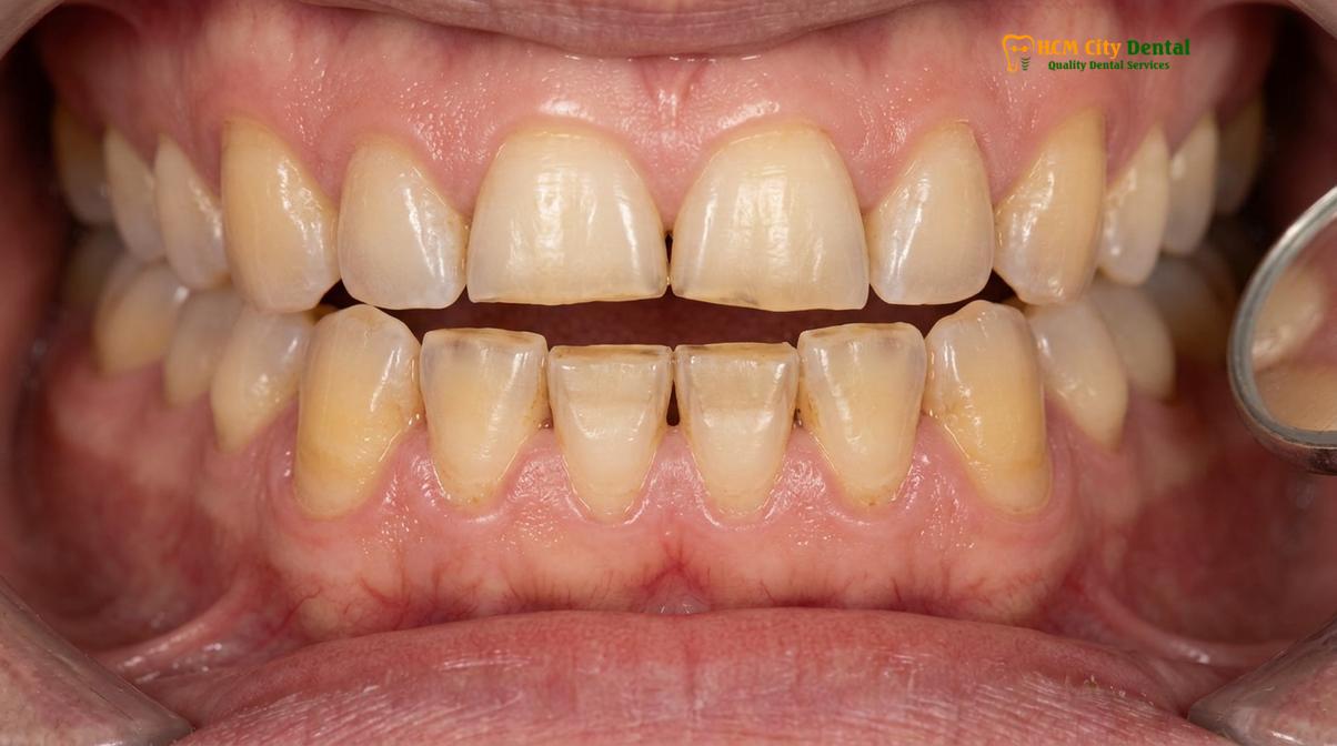Visual illustration of what is bruxism teeth grinding
