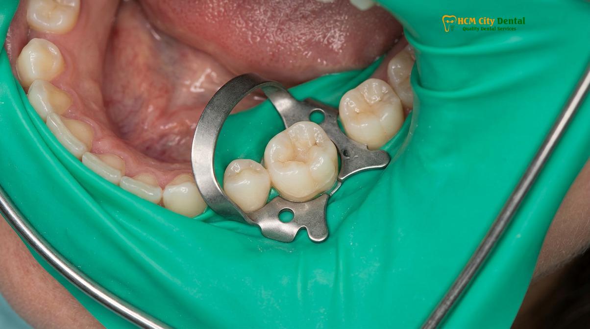 Clinical photography related to Root Canal Procedure Ho Chi Minh City