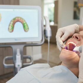 Discount Dental Veneers Vietnam: 40% Off Premium Smile Makeovers