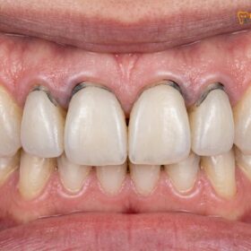 Replacing Old Veneers: Clinical Guide to Safe Removal & Upgrades