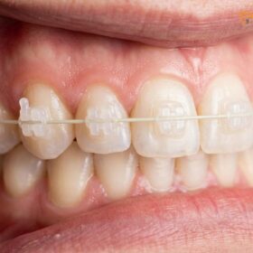 Braces Before and After: Clinical Transformations | HCMC Dental