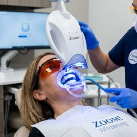 How Long Does Teeth Whitening Last? Clinical Longevity Guide