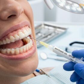 White Dental Beauty Teeth Whitening: Clinical Guide | HCMC Dental
