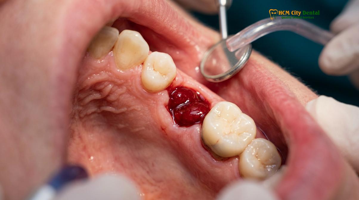 Clinical illustration of bad taste after wisdom teeth removal