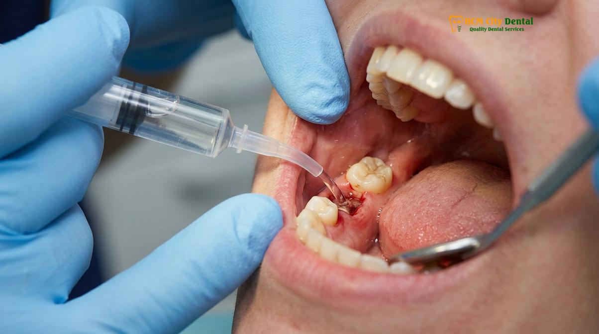 Visual description of bad taste after wisdom teeth removal