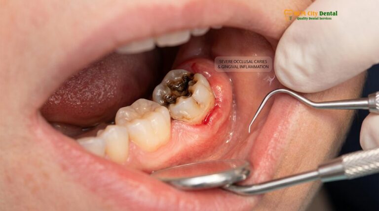 Wisdom Tooth Cavity Damage: Clinical Risks & Treatment | HCMC Dental