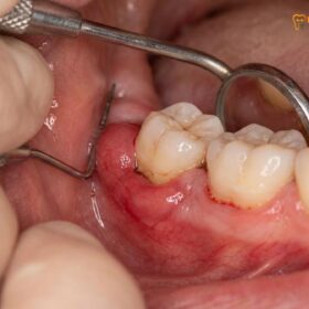 Wisdom Teeth Removal Pregnancy: Clinical Guide | HCMC Dental