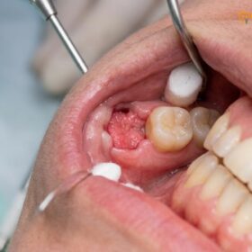 Clean Wisdom Tooth Socket: Clinical Guide & Timeline | HCMC Dental