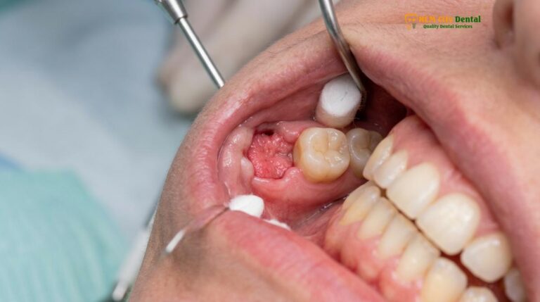 Clean Wisdom Tooth Socket: Clinical Guide & Timeline | HCMC Dental