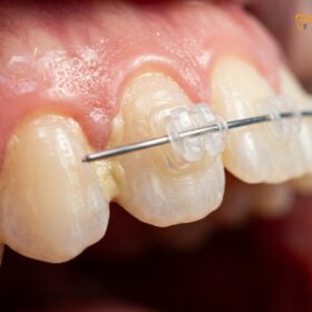 Yellow Stains Around Braces Brackets Prevention | HCMC Dental