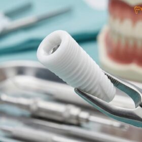 Zirconia Dental Implants: Clinical Guide | HCMC Dental
