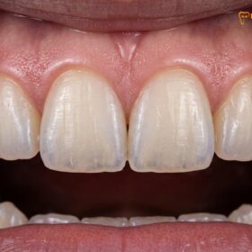 Zirconia Crown: Clinical Guide, Types & Procedure | HCMC Dental
