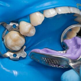 Clinical Guide to Dental Crowns in Thailand & Asia | HCMC Dental
