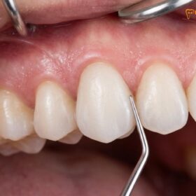 Zirconia Implant Cost Vietnam: Premium Metal-Free Guide | HCMC Dental