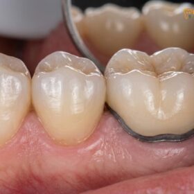 Monolithic Zirconia vs PFM: Clinical Comparison & Cost Guide