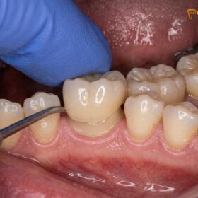 Zirconia vs Emax Crown Root Canal | HCMC Dental