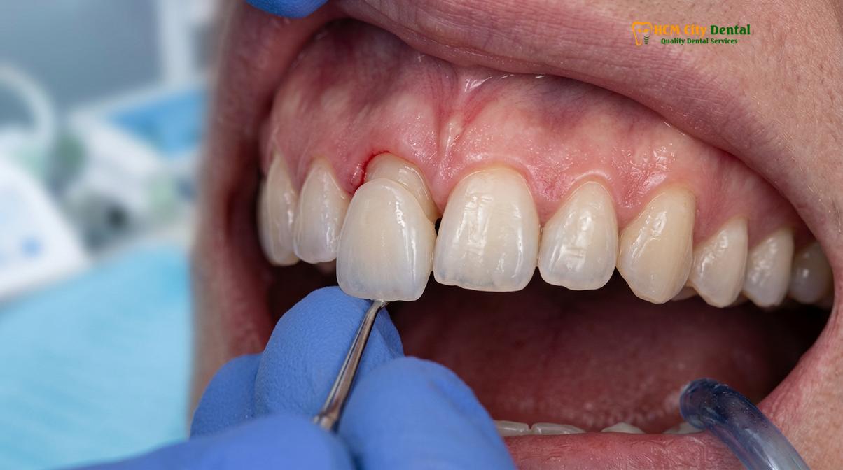 Visual description of zirconia vs emax front teeth