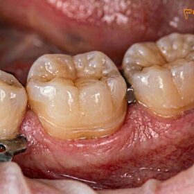 Zirconia vs Emax Overlay: Clinical Comparison & Material Guide