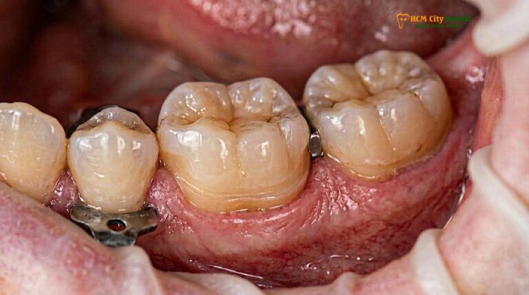 Zirconia vs Emax Overlay: Clinical Comparison & Material Guide