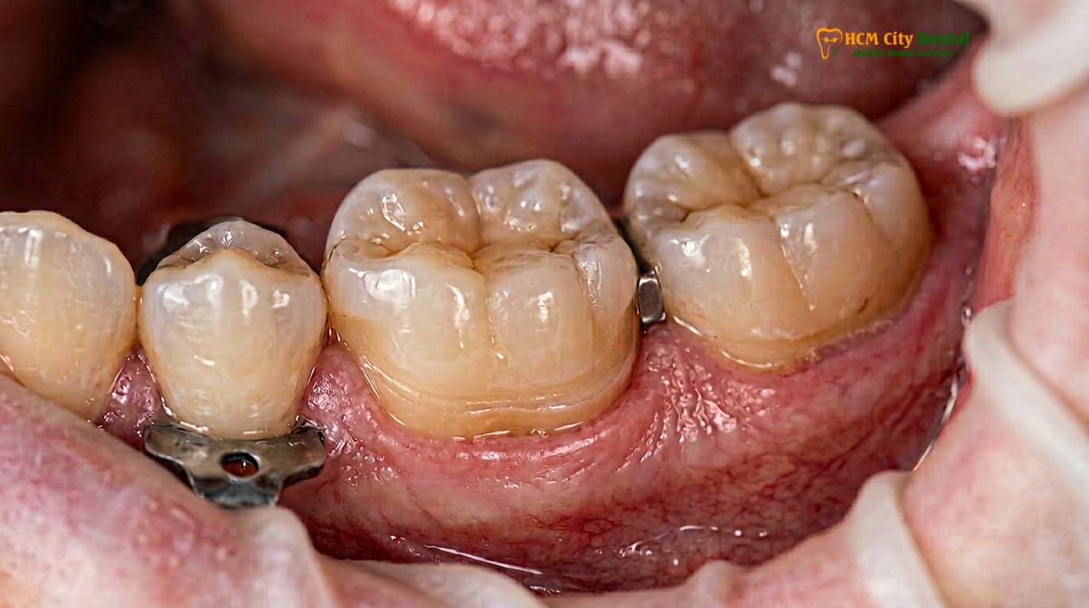 Clinical illustration of zirconia vs emax overlay
