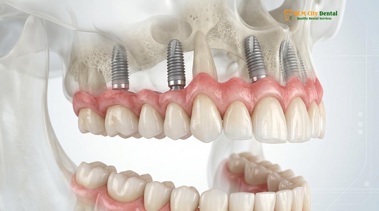 Hình ảnh lâm sàng liên quan đến all on 6 dental implants vietnam cost