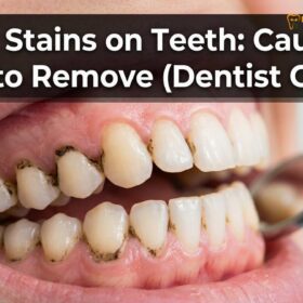 Black Stains on Teeth: Clinical Causes & Professional Removal
