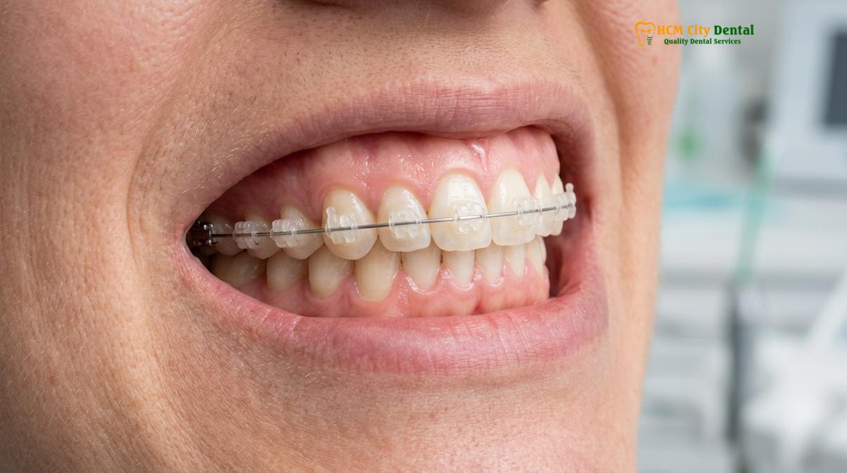 Orthodontic diagnostic planning and bracket bonding workflow