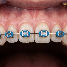 Cheap Dental Braces: Clinical Guide & Costs | HCMC Dental