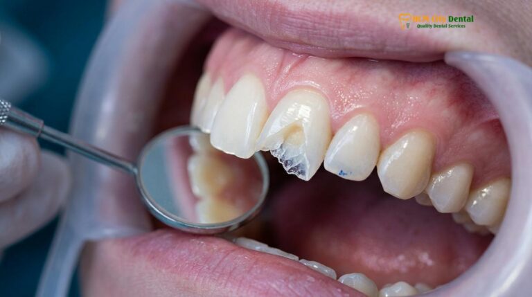 Dental Wax for Chipped Tooth: Clinical Guide & Repair | HCMC Dental