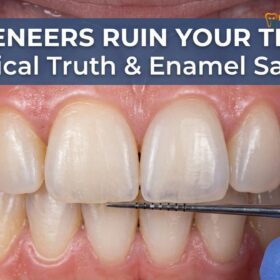 Do Veneers Ruin Your Teeth? Clinical Truths & Enamel Safety