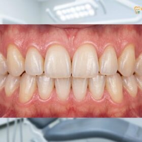 How Many Teeth Do Adults Have? Clinical Guide | HCMC Dental