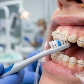 How to Keep Teeth White with Braces: Clinical Guide | HCMC Dental