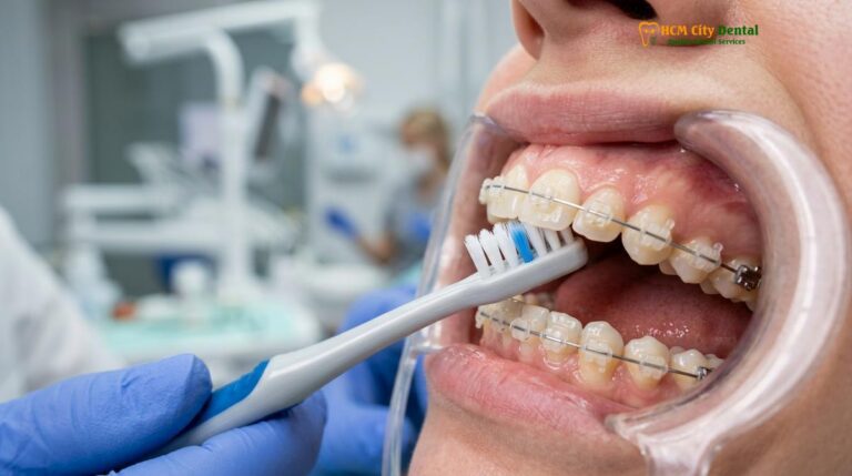 How to Keep Teeth White with Braces: Clinical Guide | HCMC Dental