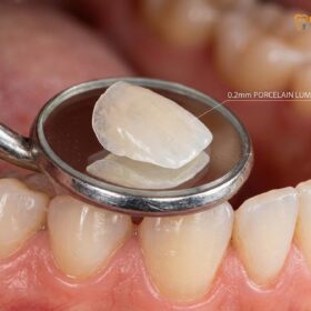 Porcelain Lumineers: Clinical Guide & Comparison | HCMC Dental