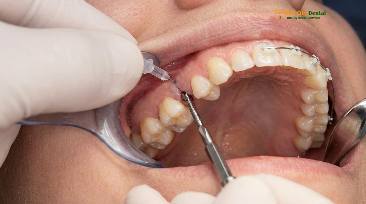 Miniscrew anchorage (TADs) utilized for complex, accelerated tooth movement.