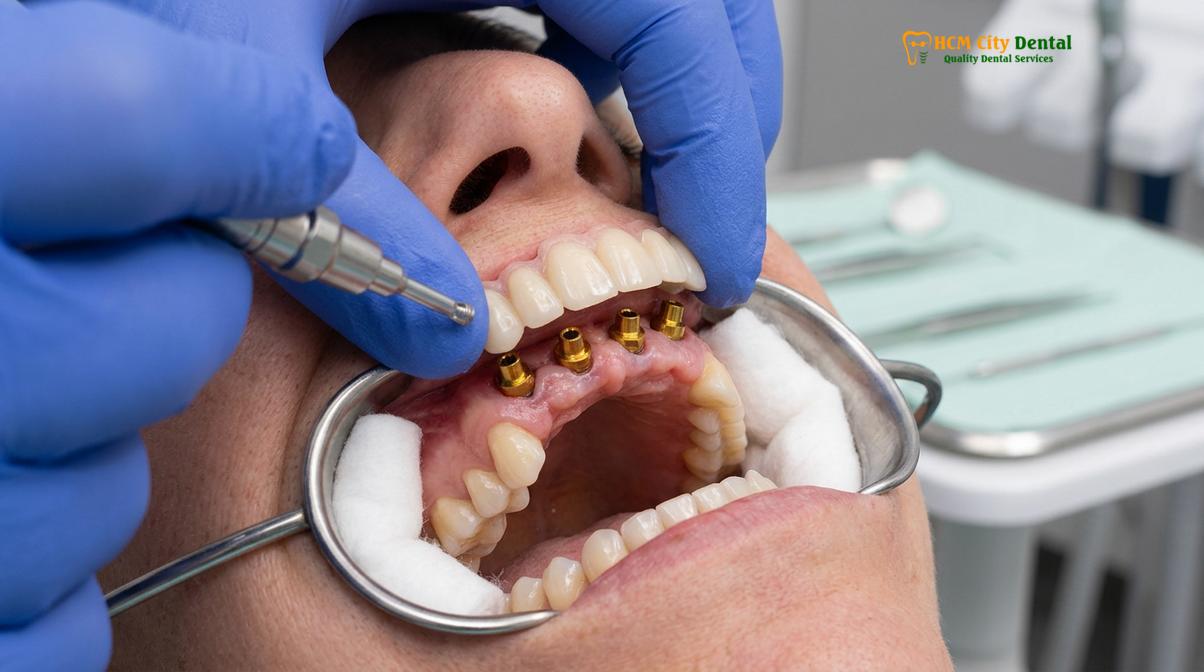 Delivery of the immediate fixed provisional bridge following surgery.