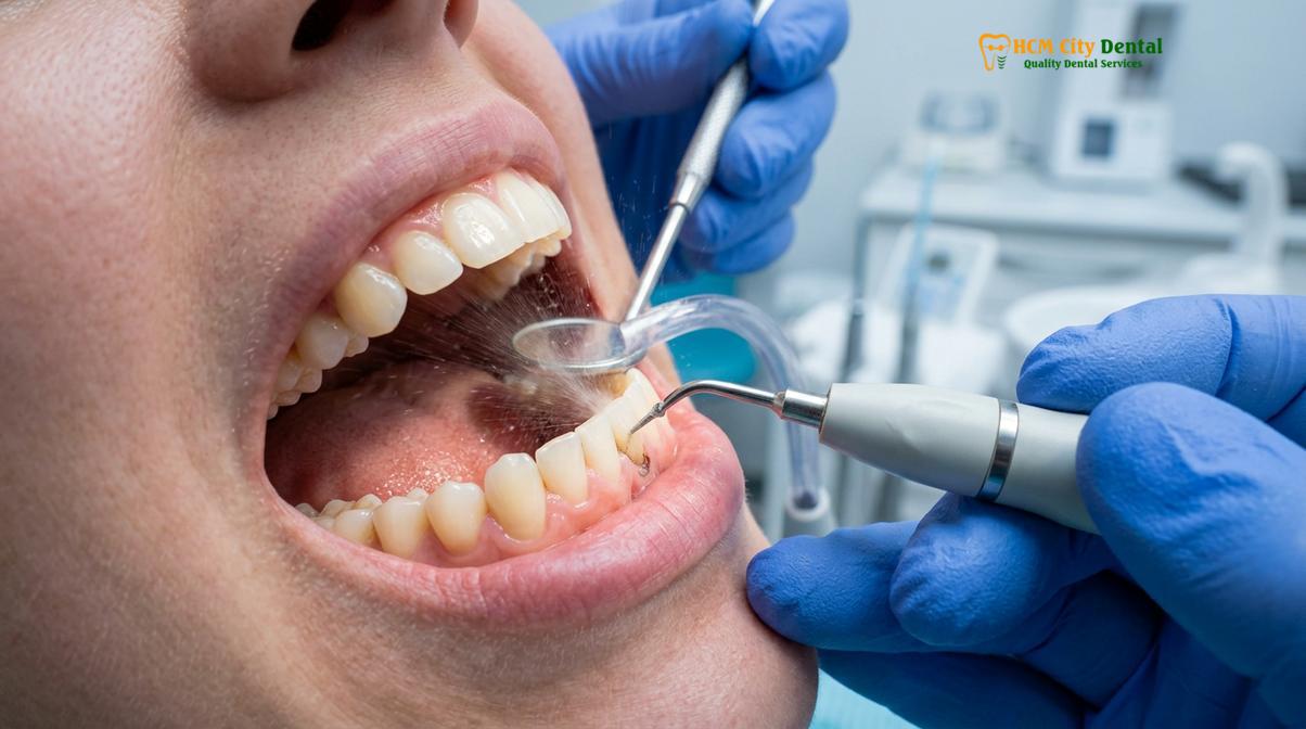 Ultrasonic piezoelectric scaling provides a comfortable, low-sensitivity cleaning experience.