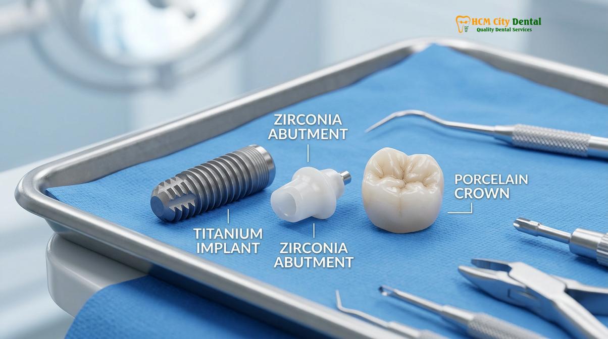 A complete dental implant system consists of the titanium fixture, the connecting abutment, and the final custom crown.