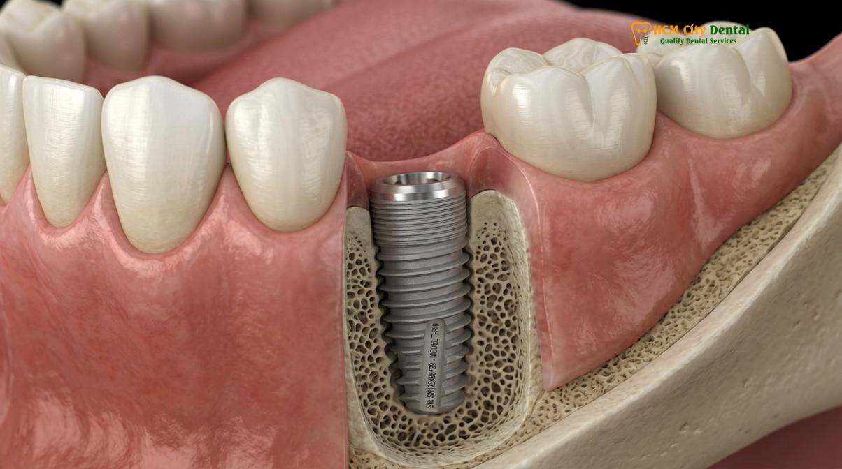 Authentic dental implants from reputable brands include traceable serial numbers for global warranty verification.