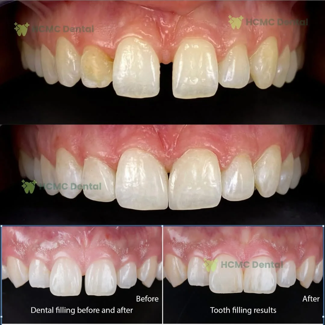 Anterior Chipped Tooth Cosmetic Restoration Dr Cuong Saigon