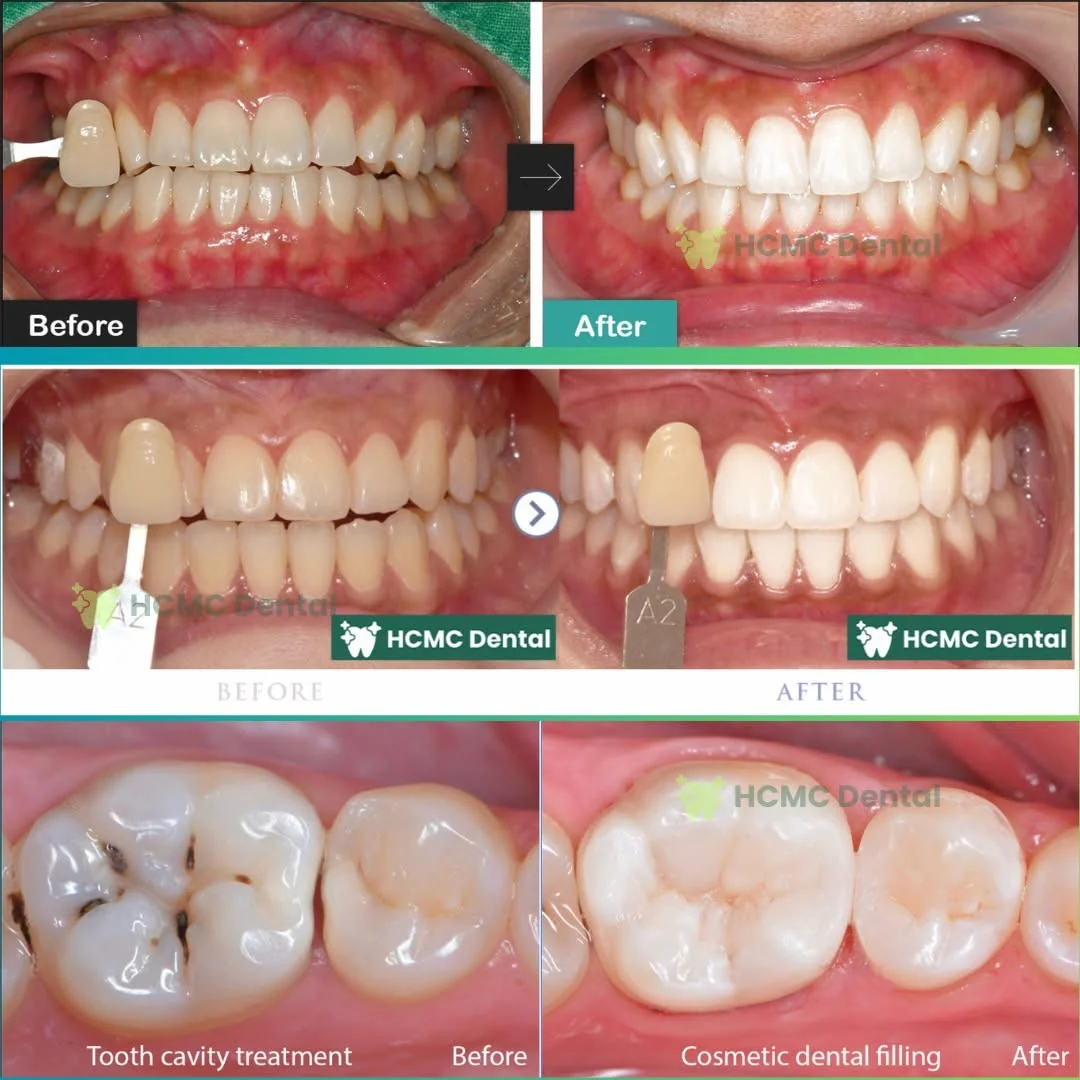 Full smile transformation after in-office laser whitening at HCMC Dental Clinic Saigon