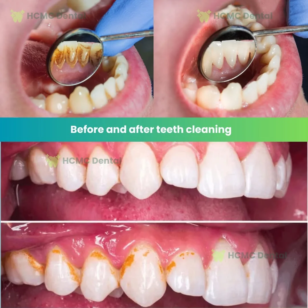 Ultrasonic Tartar Scaling and Deep Cleaning Before After HCMC Dental