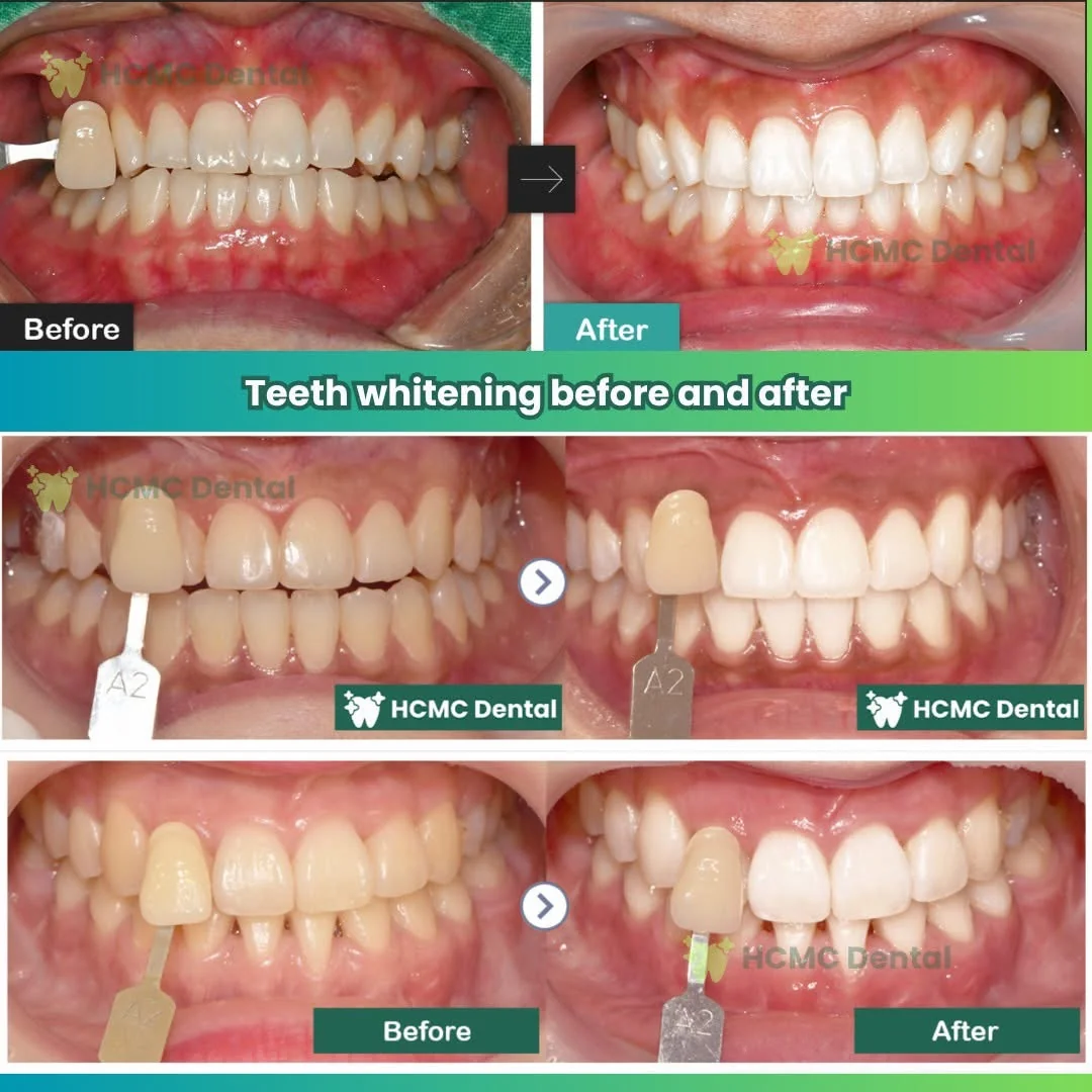 In Office Zoom Laser Whitening Shade Guide Results Dr Cuong Saigon